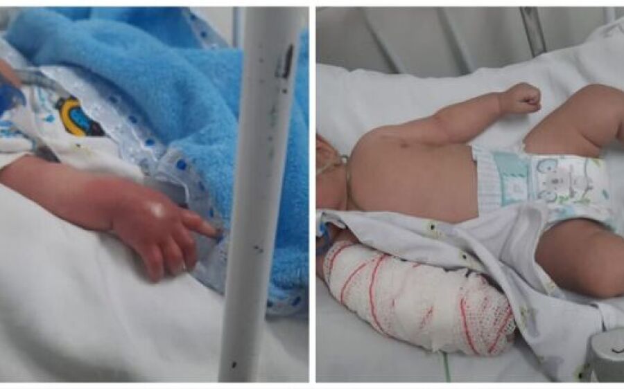 Bebê internado por problema respiratória ganha braço inchado na Santa Casa