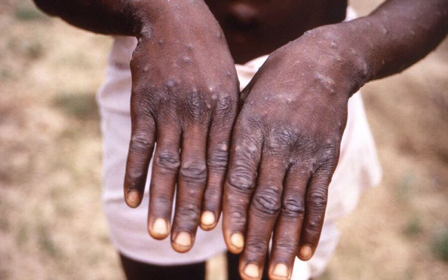 SES registra primeiro caso suspeito de  Monkeypox em MS
