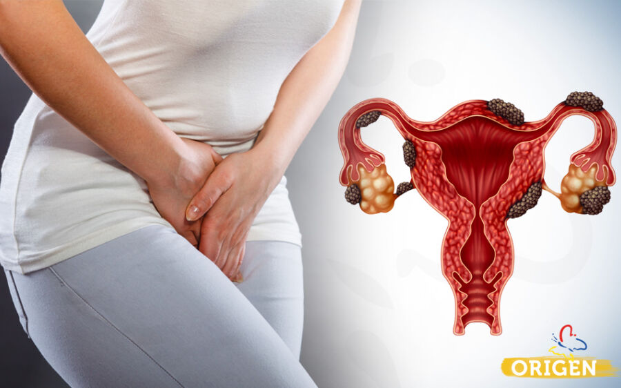 Endometriose, como diagnosticar e tratar