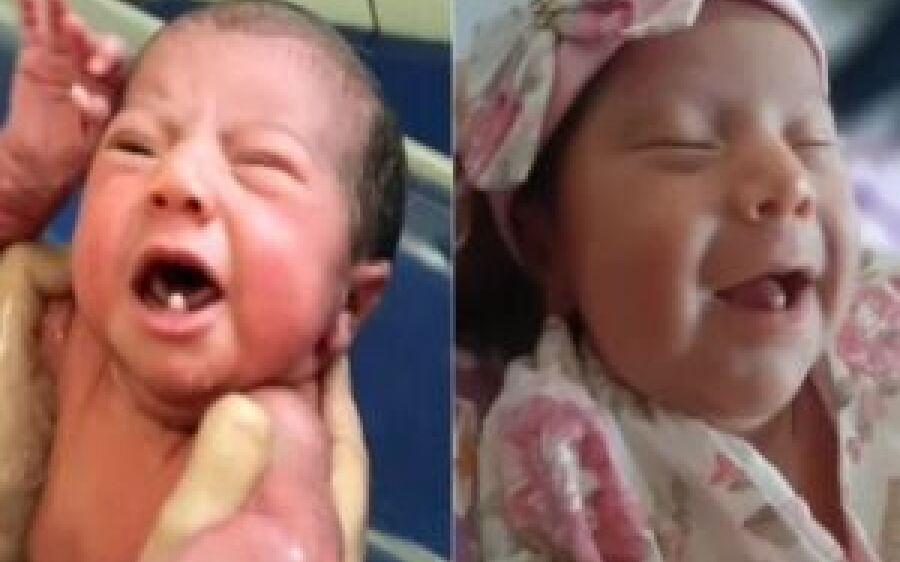 Bebê nasce com dois dentes e viraliza nas redes sociais