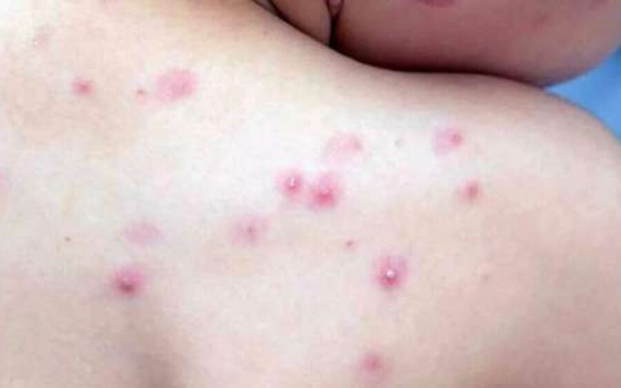 Sesau rastreou pessoas que tiveram contato com aluno de Emei que contraiu varíola dos macacos