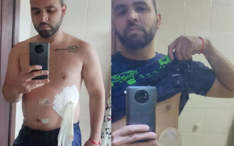 CRM-PR abre investigação contra médico que colocou luva no lugar de bolsa de colostomia