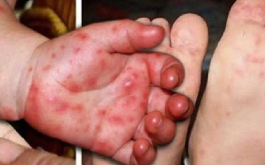 Em meio a surto de doenças respiratórias em crianças, mão-pé-boca se espalha