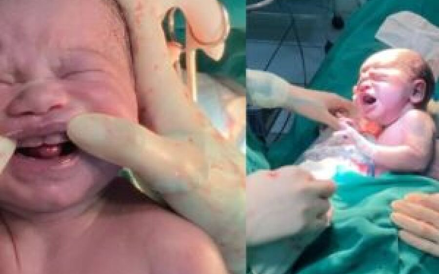 Bebê surpreende pais e equipe médica ao nascer com seis dentes em maternidade de MS