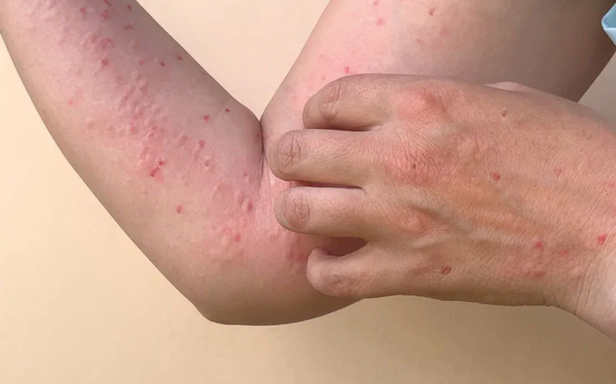 MPOX: Você conhece a doença que está deixando em alerta o mundo todo?