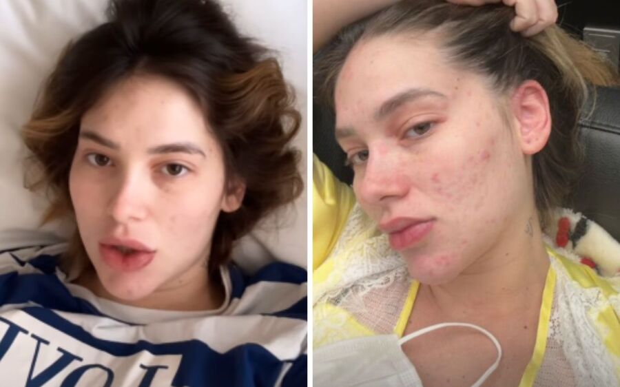 Virginia Fonseca tem piora em reação alérgica e é internada