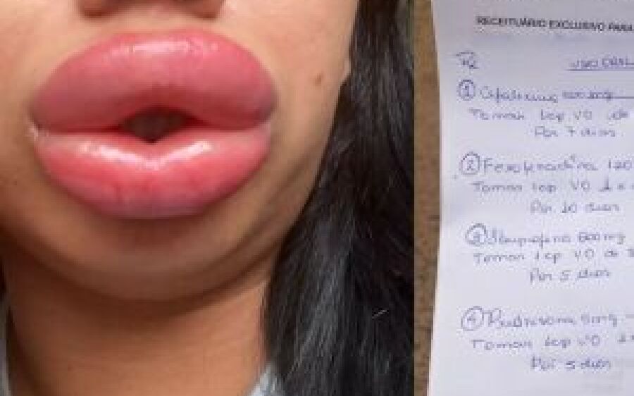 Estudante de biomedicina que promete bocão da Angelina Jolie fere paciente modelo com ácido